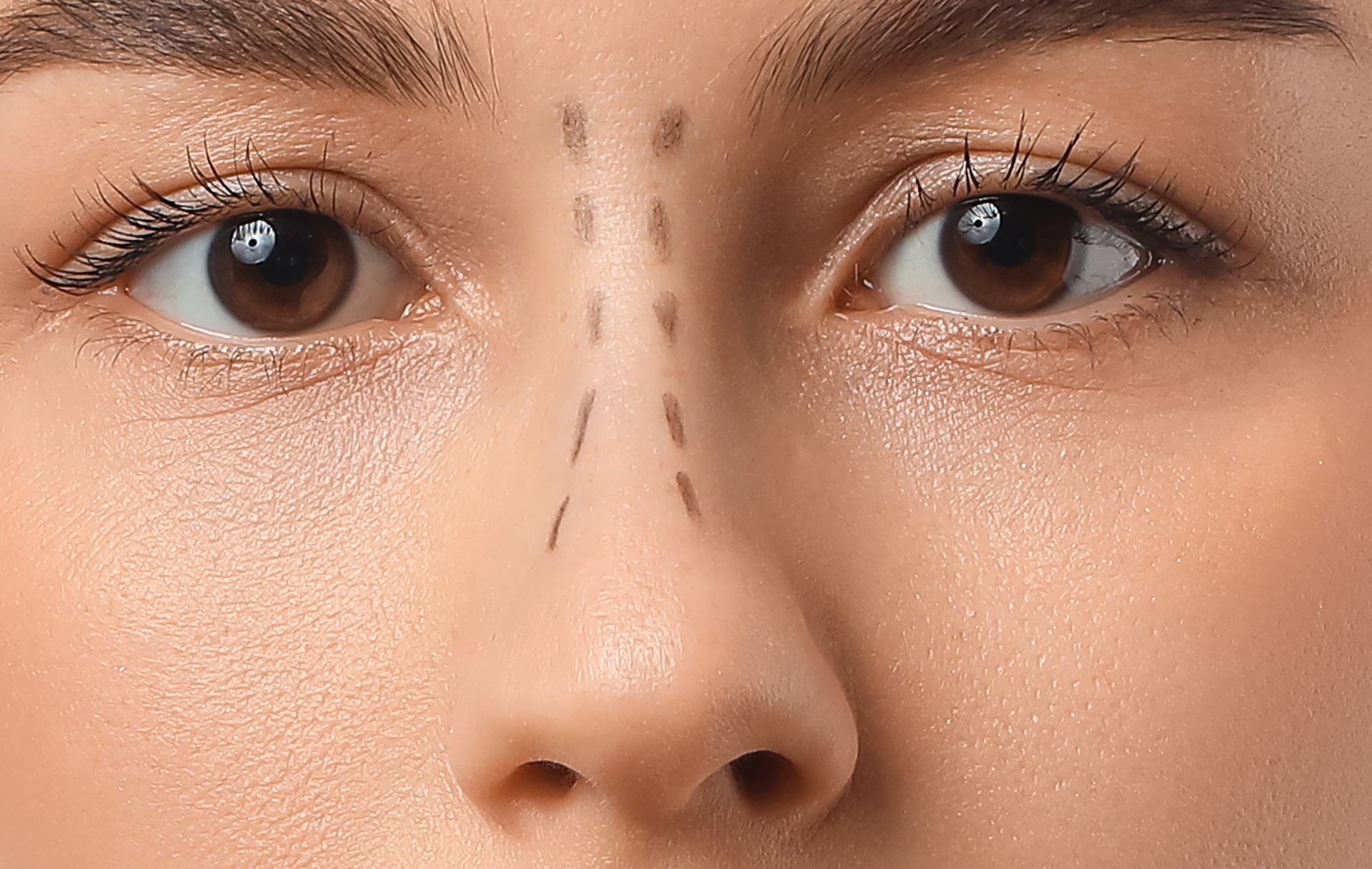 rhinoplastie